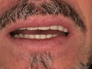 última fase implante dental